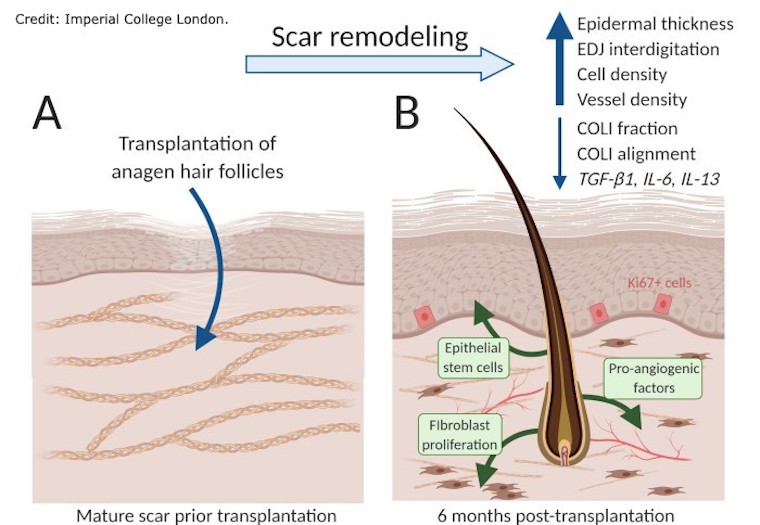 hair follicles