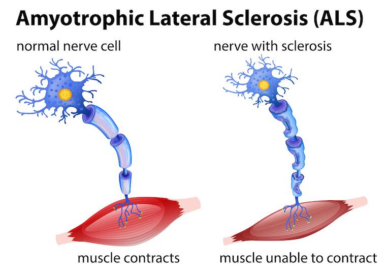 ALS nerve cells